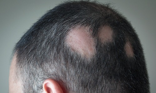 Ritlecitinib, para la alopecia areata grave, aprobado como primer tratamiento que inhibe la JAK3